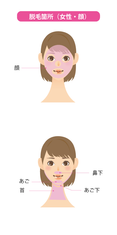IPL脱毛　女性