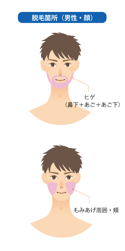 IPL脱毛　男性